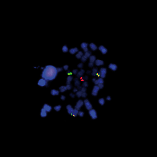 KMT2A/MLLT1 t(11;19) Fusion product photo