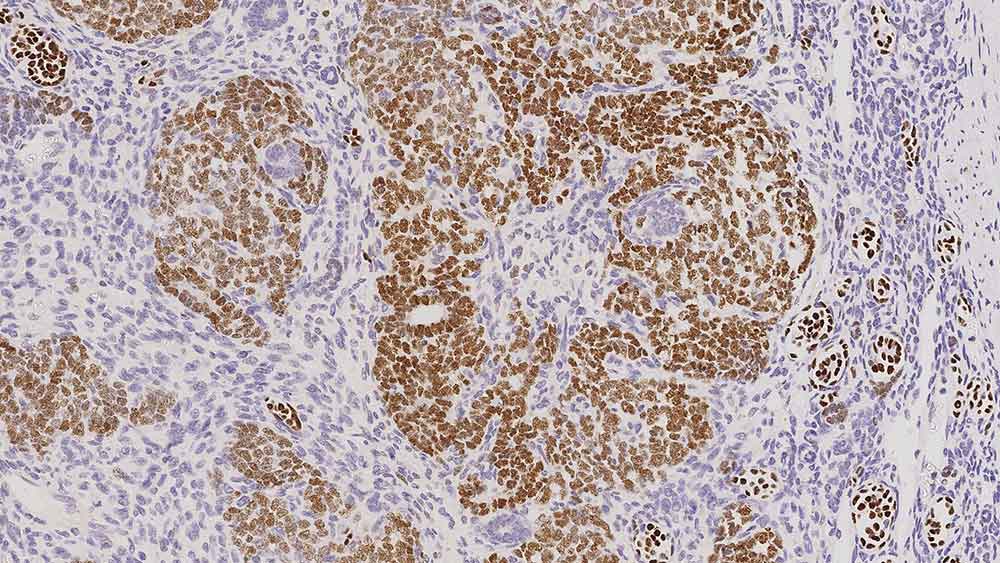 Wilms' Tumor product photo Front View S