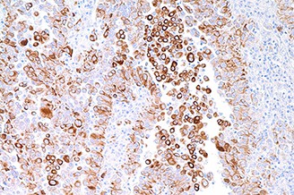 Cytokeratin 5 & 6 (D5 & 16B4) product photo