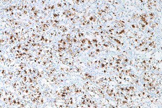 Renal Cell Carcinoma (PN-15) product photo