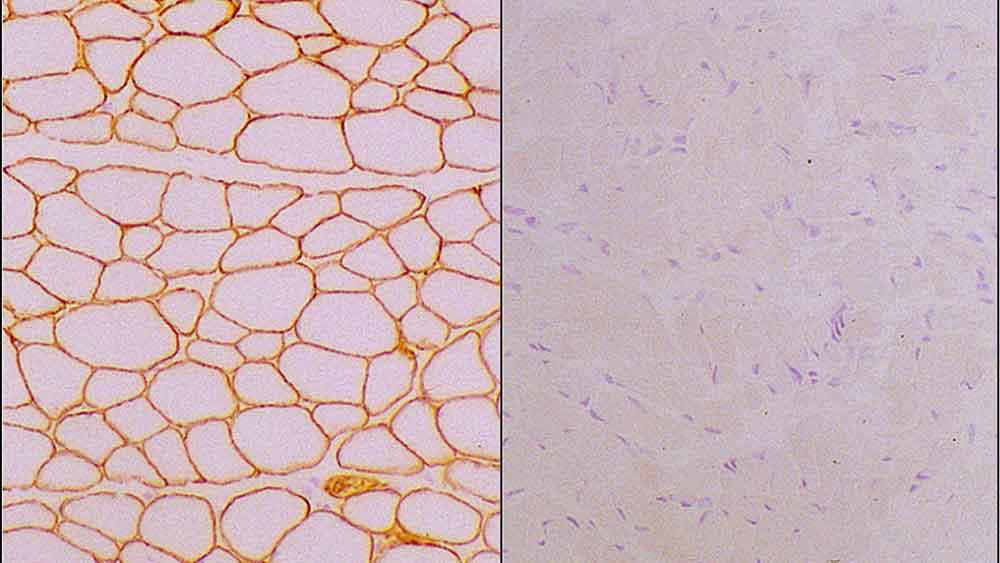 1ml NCL-MEROSIN product photo